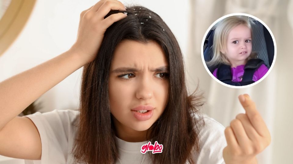 ¿Qué hacer para eliminar la caspa definitivamente? Aquí te presentamos el remedio natural para acabar con la picazón.
