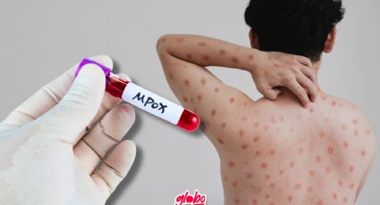 Casos de Viruela del mono en México 2024: ¿En qué estados se han registrado más contagios de Mpox?