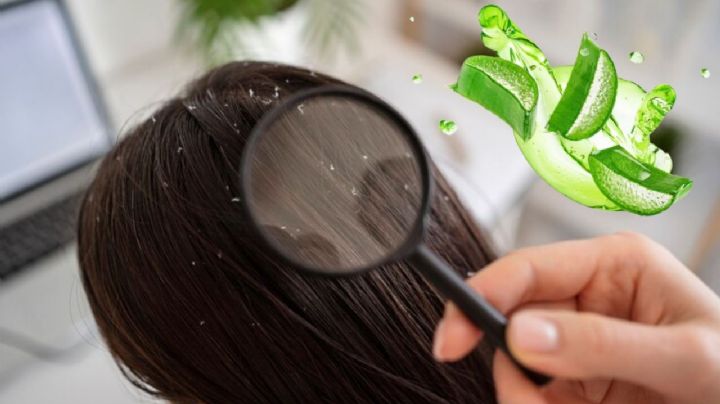 ¿Cómo eliminar la caspa con aloe vera?