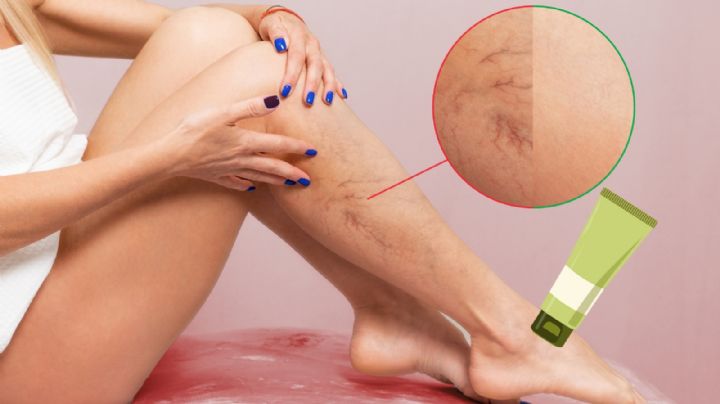 Las 3 mejores cremas para várices recomendadas los expertos
