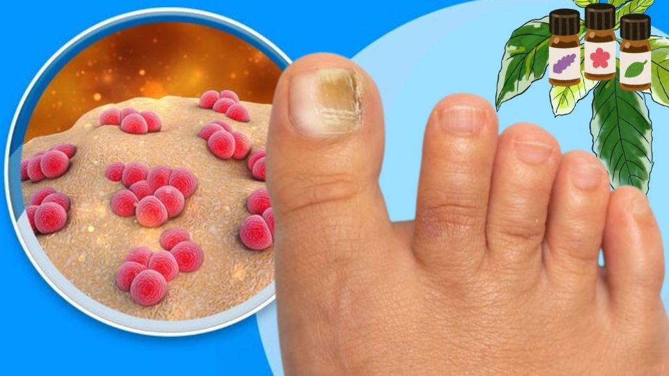 Los hongos en las uñas de los pies, son infecciones causadas principalmente por hongos dermatofitos.